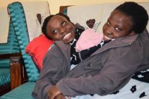 CONJOINED TWINS PASSES ON
